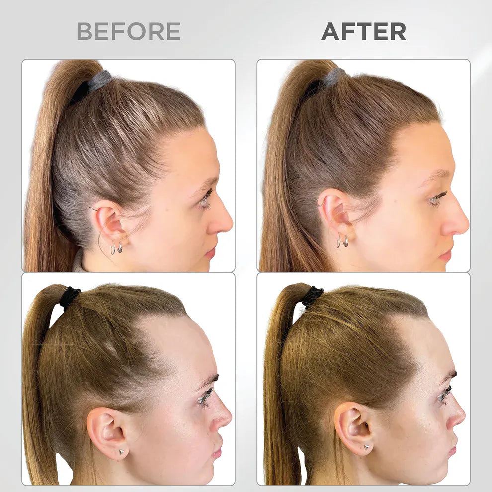 Líora Hair — before and after, temples on light brown hair