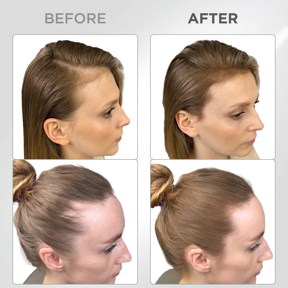 Líora Hair — before and after, hairline fill on golden brown hair